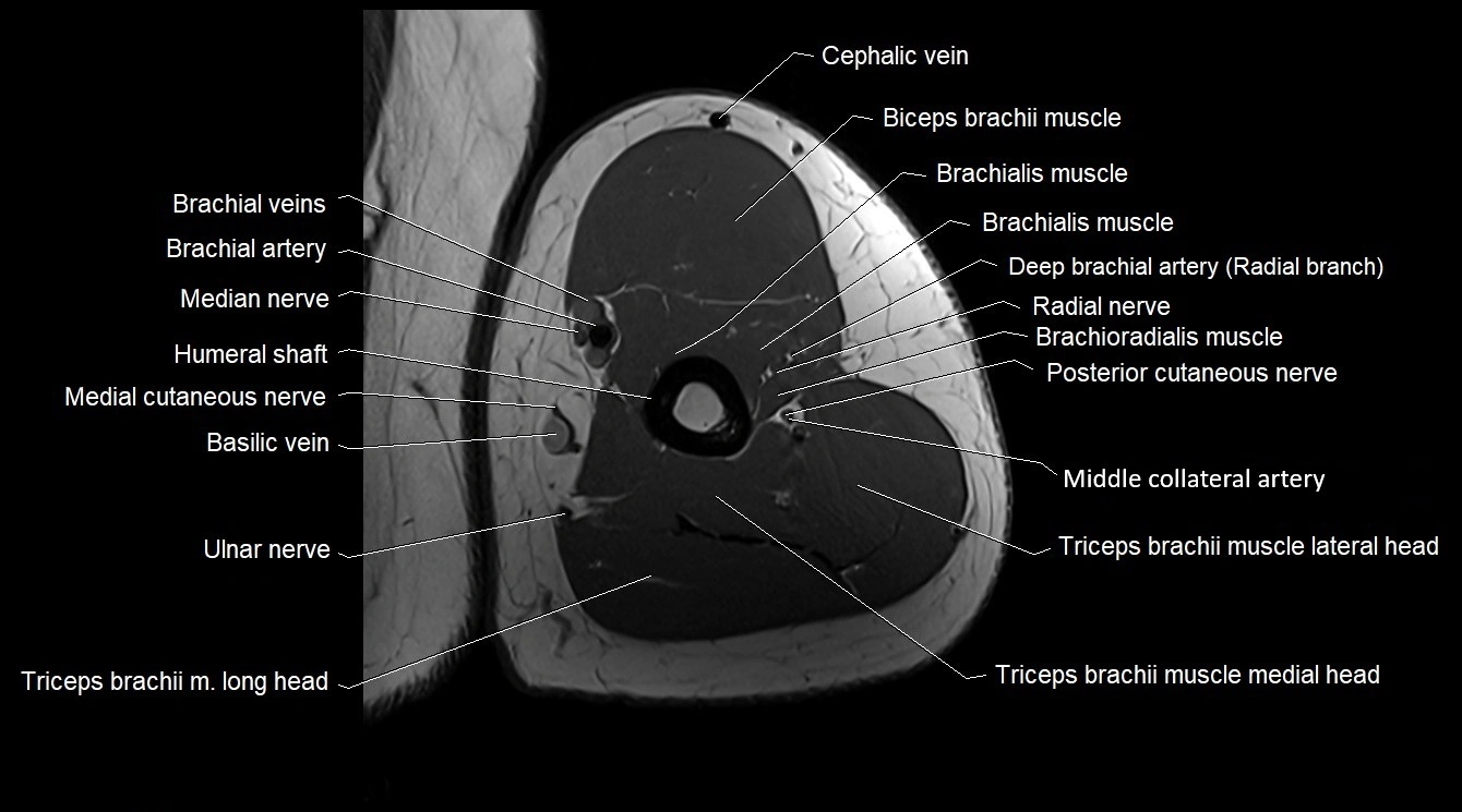 Upper arm( humerus) cross section anatomy MRI 3T axial image 41.webp